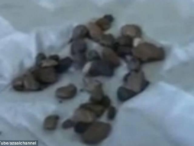 गुर्दे की पथरी गलाने वाली नई दवा america_stone
