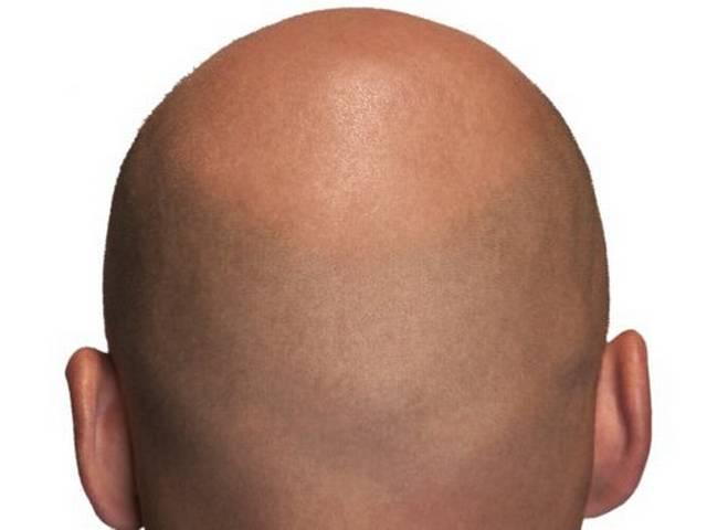 गंजो के लिए खुशखबरी good new for bald people
