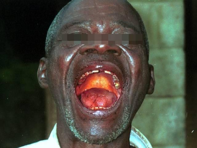 पश्चिम अफ्रीका में तेजी से बढ़ रहा इबोला ebola is spreading very fast in west africa