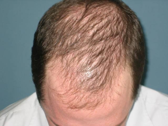 पुराने 200 बाल तोड़कर पाएं 1200 नए! hair loss problem