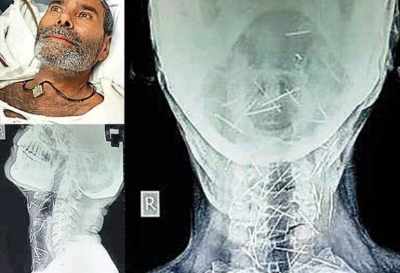 রাজস্থানে এক ব্যক্তির দেহে ঢুকে আছে ৭৫টি পিন, কীভাবে বের করবেন? ধন্দে চিকিত্সকরা