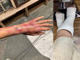 Tapsee Panu Getting Injured During The Upcoming movie Game Over शूटिंग करते वक्त ताप्सी पन्नू हुई घायल, जला हाथ, पैरों में चढ़ा प्लास्टर, देखे तस्वीरें