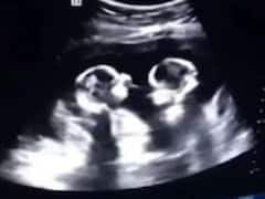 रेडियोलॉजिस्ट ने अल्ट्रासाउंड रिपोर्ट को बताया सही, बड़ा सवाल- आखिर कहां गया दूसरा बच्चा 